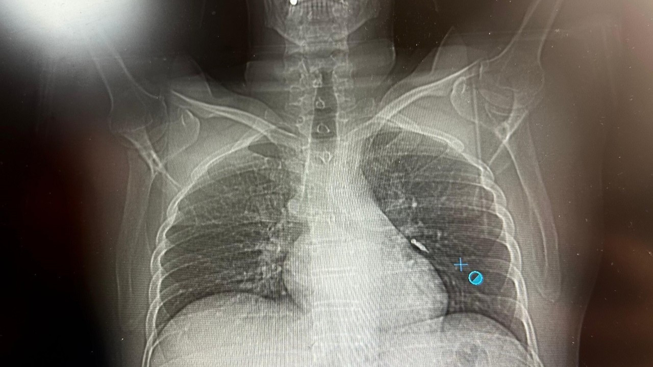 İmplant vidası ciğerine kaçtı! Hasta ölümden döndü