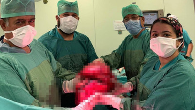 Yemek yiyememe şikayetiyle hastaneye başvuran 71 yaşındaki kadının karnından 9 kilo tümör çıkarıldı