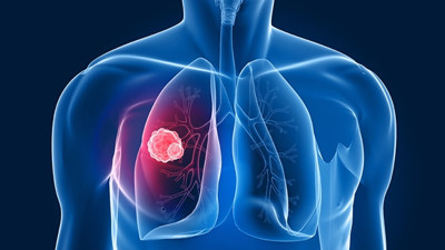 'Elektronik sigara akciğer kanseri riskini artırıyor'