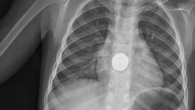 Yuttuğu pil yemek borusunu yaktı