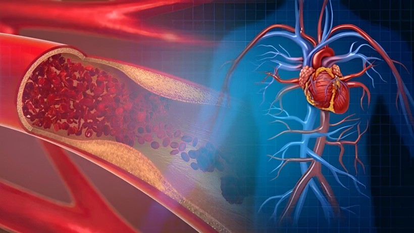 Aort damarı yırtılması nedir? Aort damarı yırtılması belirtileri