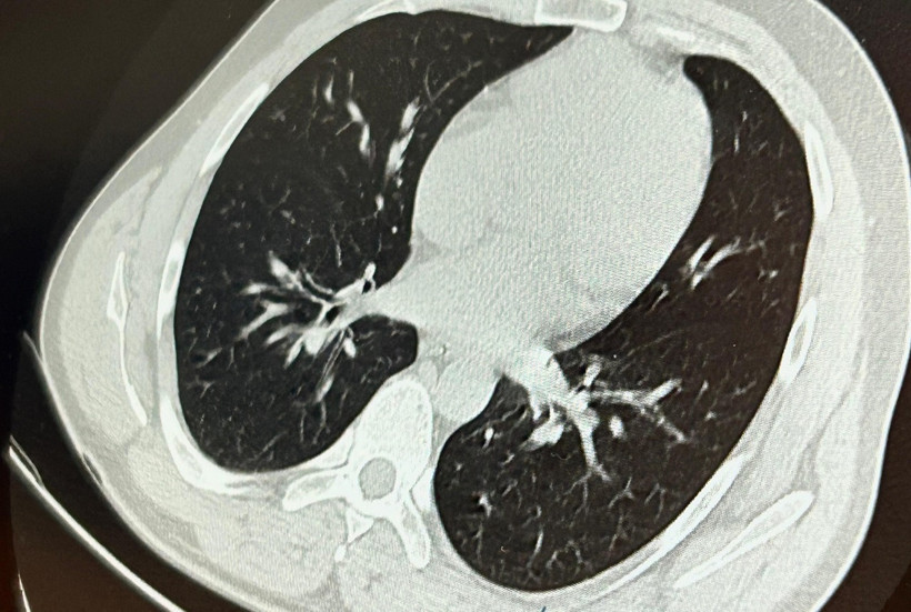 İmplant vidası ciğerine kaçtı! Hasta ölümden döndü - Resim : 1